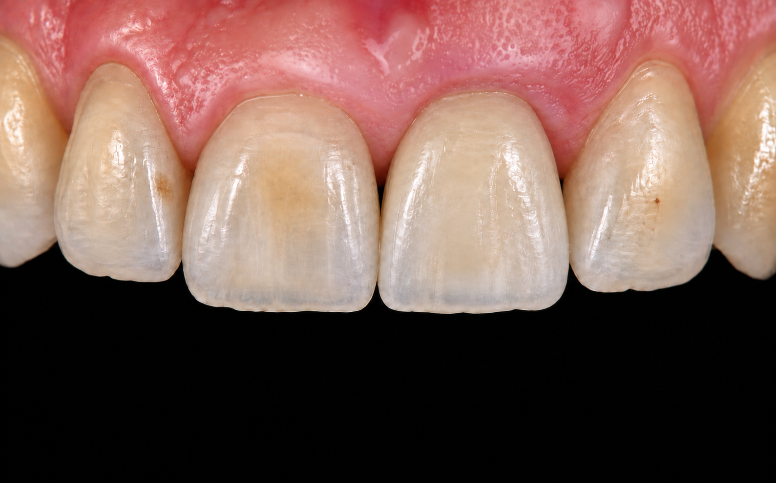 Corona definitiva sobre implante dental
