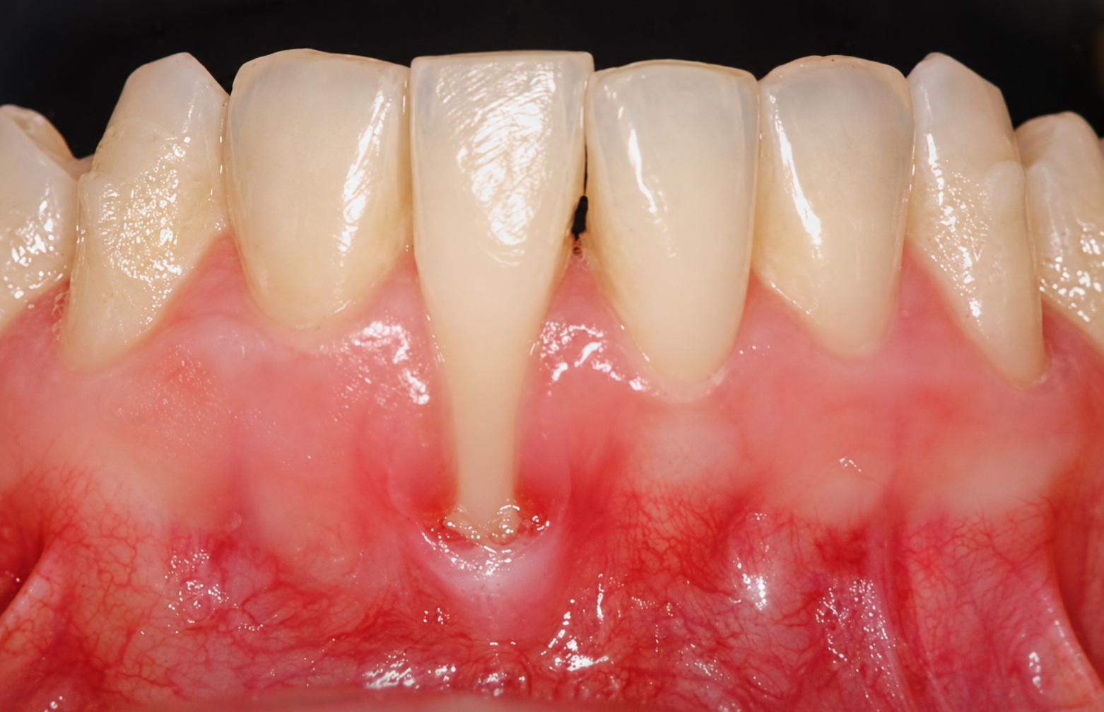 Recesión de encía: caso de la página de Periodoncia